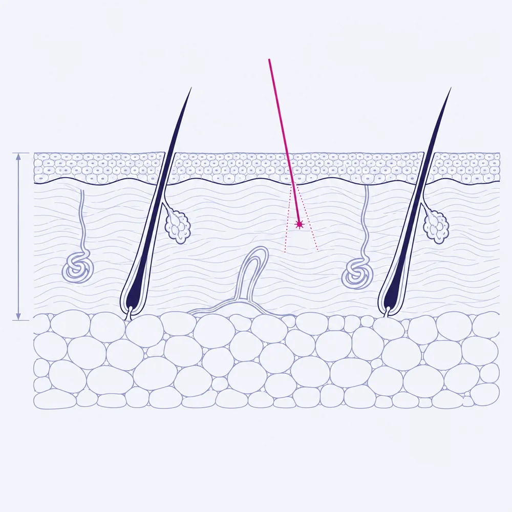 A cross section through skin: the outer layer, the dermis with its fibres, glands and follicles, and the fat cells beneath, with a beam entering to a focal depth