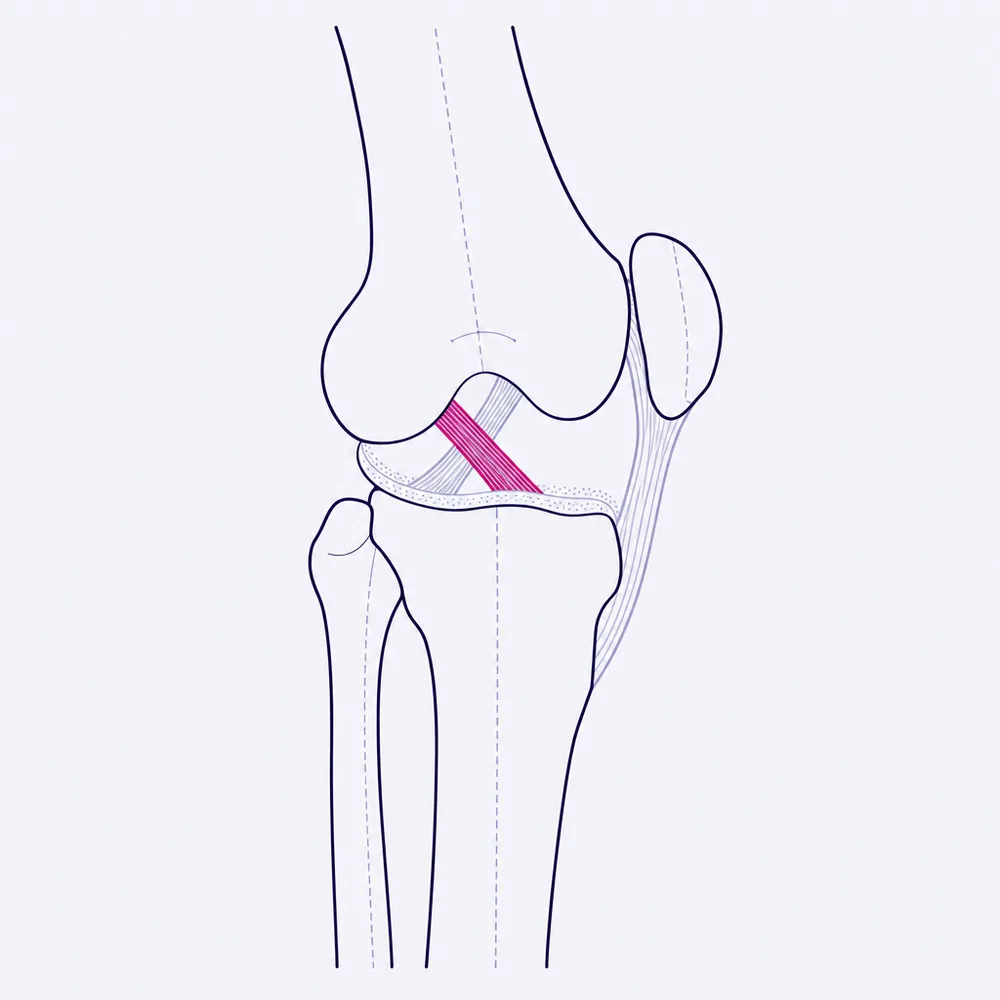 A knee joint in side elevation: femur, tibia, fibula and patella, with the cruciate ligaments crossing inside the joint